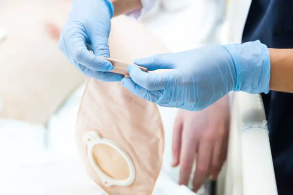 Stoma und chronische Wunden: Pflegekraft versorgt Patienten Stoma und chronische Wunden: Pflegekraft versorgt Patienten
